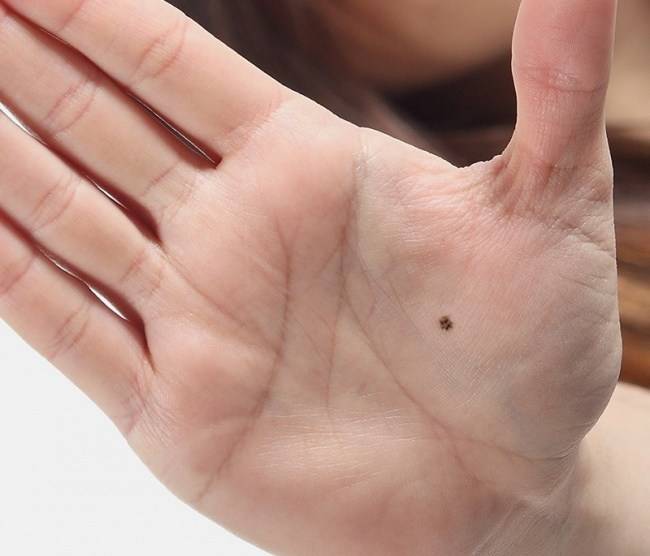 Is it lucky to have a mole on palm or not? - Letsdiskuss