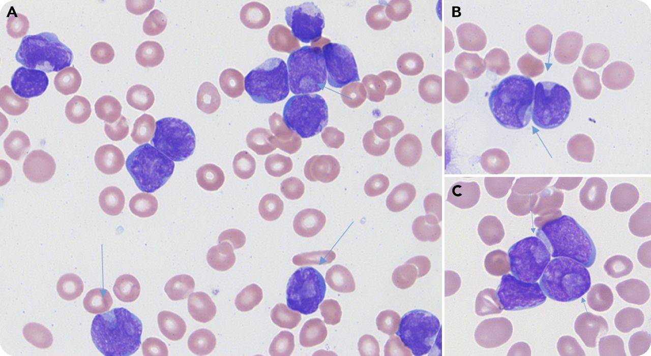 What is Acute Lymphoblastic Leukemia ? - letsdiskuss