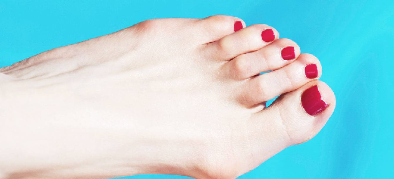 How To Remove Bunions Naturally